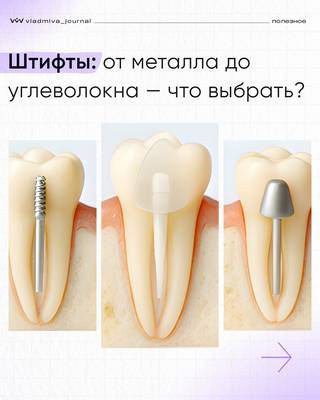 Штифты: от анкера до стекловолокна — выбор материала.